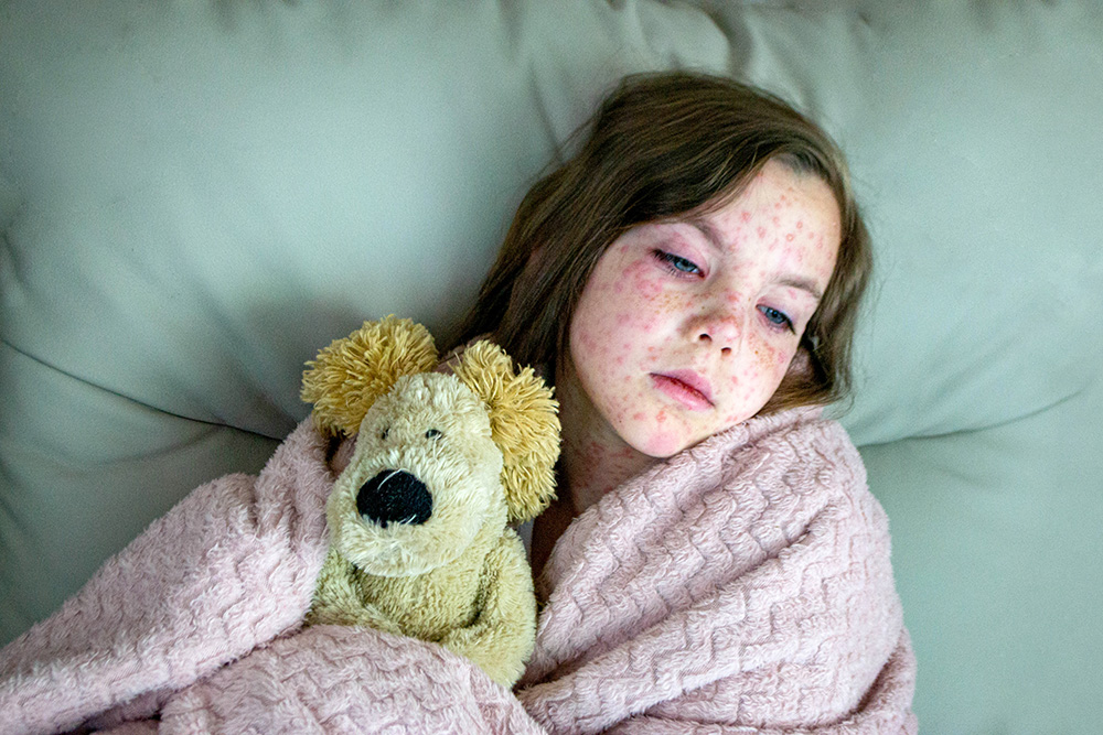 Harris County Investigates Measles Case in Unvaccinated Child with No Travel History